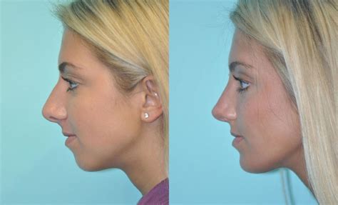 chin facial implant  chevy chase md patient