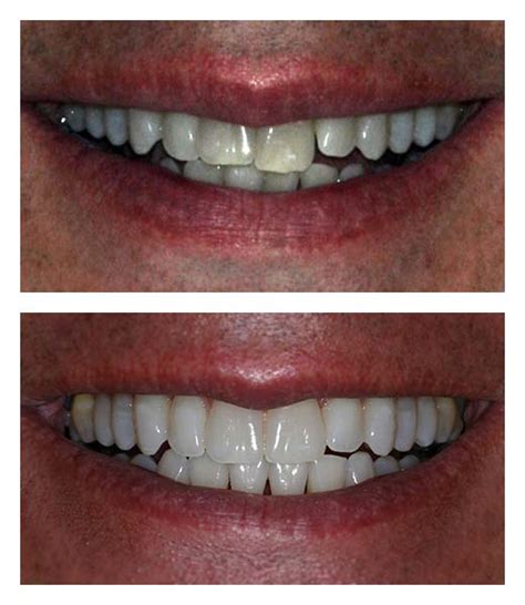 Clear Braces Before And After Bartholomew Dentist