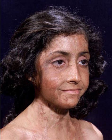 burn victim  amazing facial reconstruction barnorama