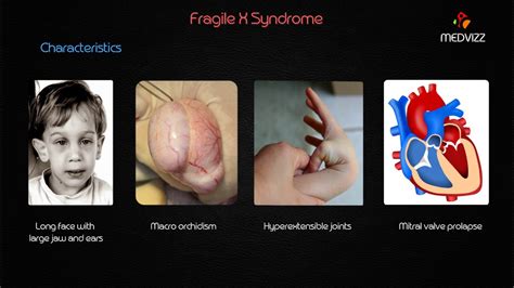 Fragile X Syndrome Usmle Genetics Lecture Youtube
