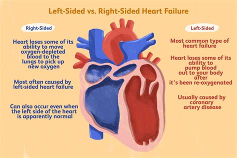 left   sided heart failure