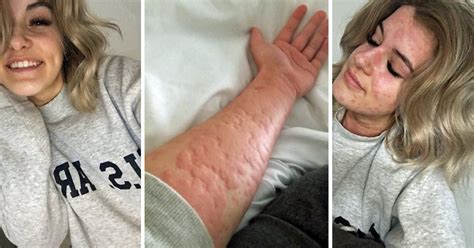 21 Year Old Woman Is Allergic To Winter And Cold Weather Can Leave Her