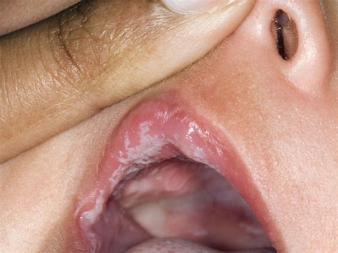 Can scabies spread from oral sex