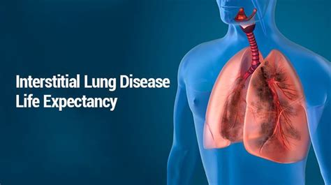 Interstitial Lung Disease Life Expectancy Disease Expectancy