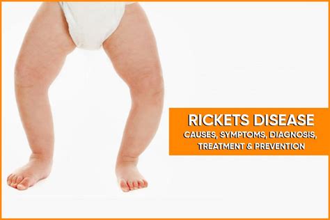 Rickets Disease – Causes Symptoms Diagnosis Treatment And Prevention