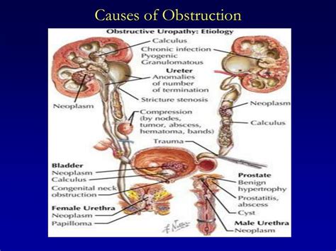 obstructive uropathy powerpoint  id