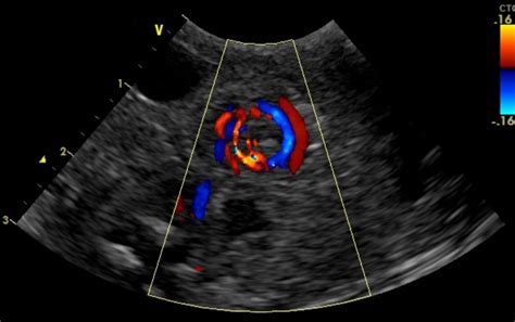 whirlpool sign  ultrasound imaging   preterm infant  suspected malrotation volvulus