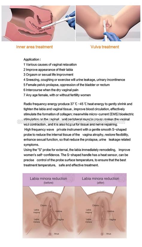 use in vaginal rejuvenation radio frequency and vaginal tightening rf beauty device