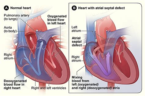 congenital heart defects nhlbi nih