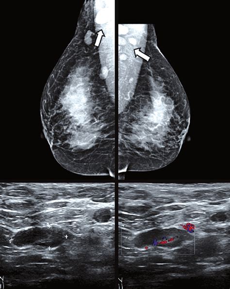 Multiple Bilateral Enlarged Dense Lymph Nodes Were Detected On A