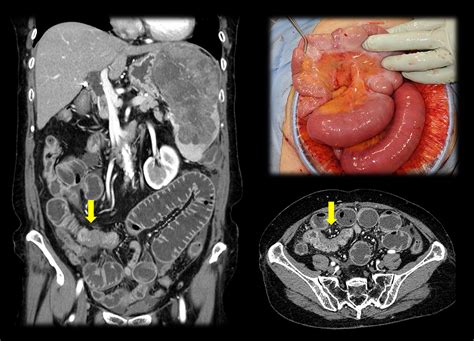 splenic and peritoneal metastases with para aortic and virchow lymph