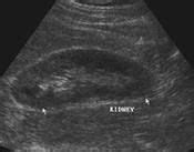 normal kidney ultrasound google search medicineultrasound