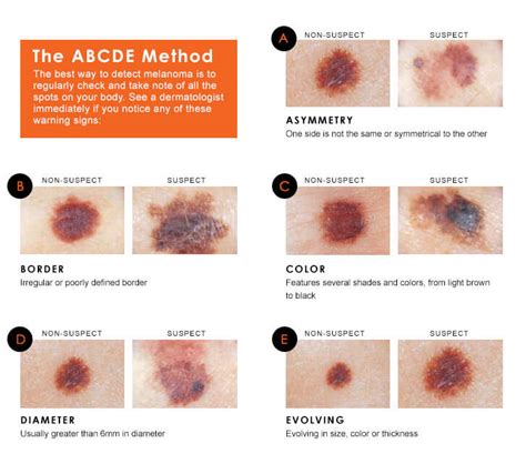 Skin Cancer Signs And Symptoms