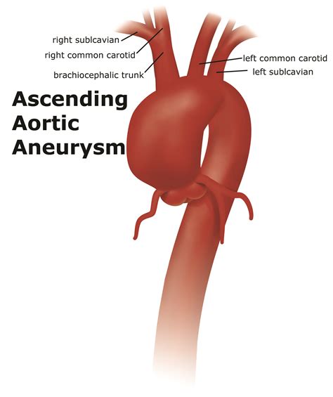 thoracic aortic aneurysm uf health aortic disease centerdiseases
