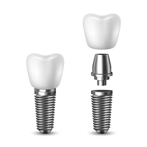 dental implants memphis dentures  implants