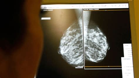 Most Breast Cancer Patients Who Have Double Mastectomy Dont Need It