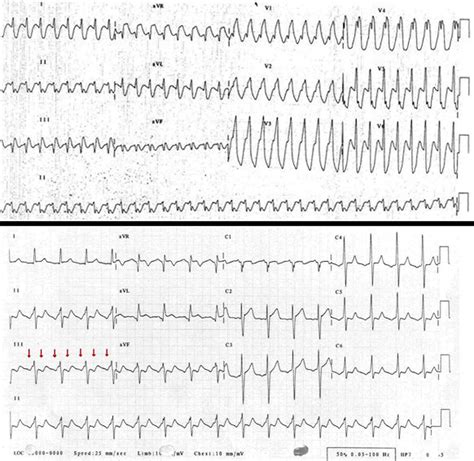 tachycardia due to atrial flutter with rapid 1 1 conduction following