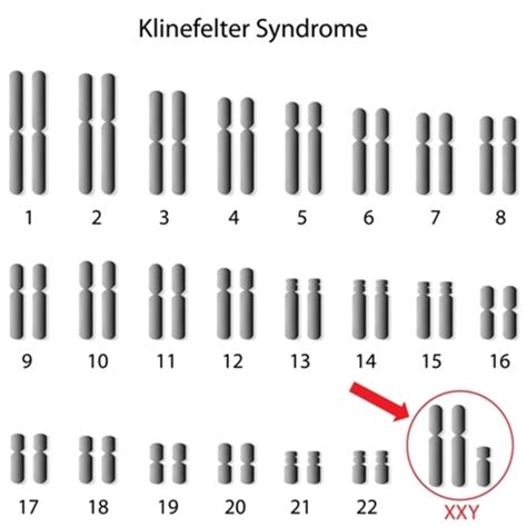 Klinefelter Syndrome Genetics Home Reference Nih