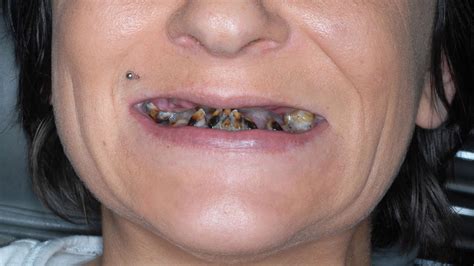 oralphobie die angst vorm zahnarzt nicole putzte 15 jahre lang ihre