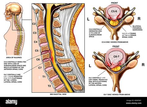 la cirugía de la columna vertebral 6 c5 y c6 de 7 discos con