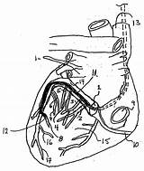 Patents Catheter Sinus Coronary sketch template