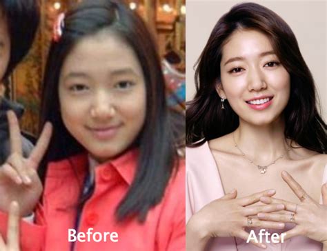 Kim Soo Shin Plastic Surgery Plastic Surgery Celebrity