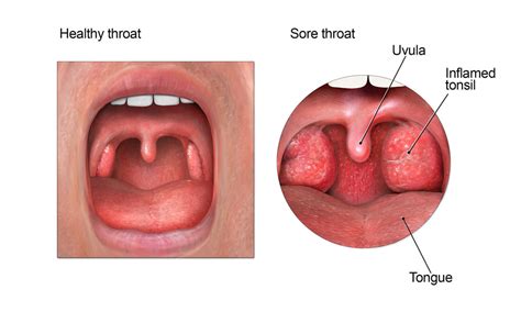 how to cure a sore [strep] throat fast public health