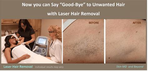 how well does laser hair removal work laser hair removal