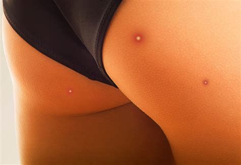 Butt Acne Causes And Treatments