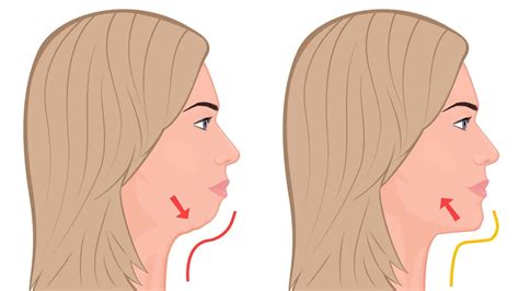 What Causes A Double Chin How To Fix Exercises And Home