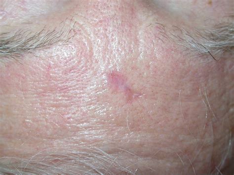 basal cell cancer bcc skin repair