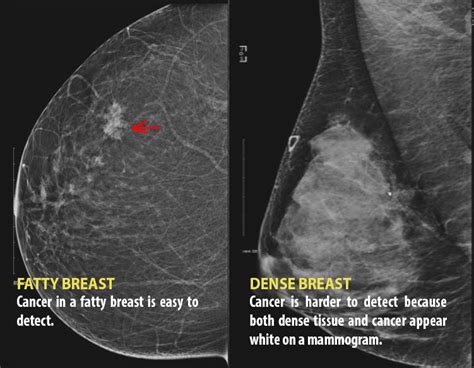 We Need To Talk About Dense Breasts Why Governments Are Taking Notice