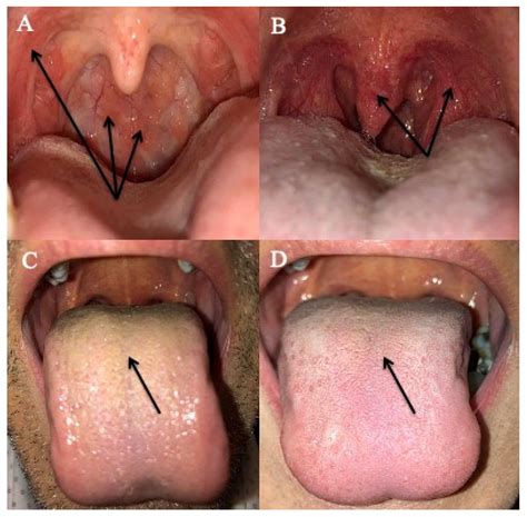Jcm Free Full Text Laryngopharyngeal Reflux A State Of The Art