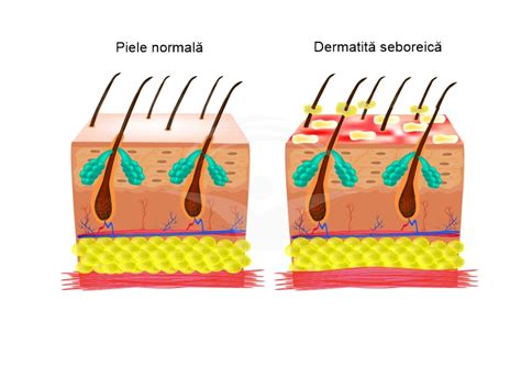 Dermatita Seboreica Factori Favorizanti Si Tratament