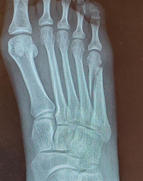 My 5th Metatarsal Fracture Ouch R Medizzy