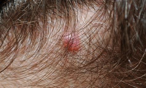moles  scalp