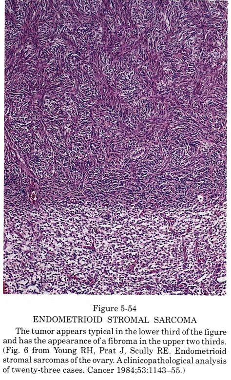 Pathology Outlines Endometrial Stromal Sarcoma