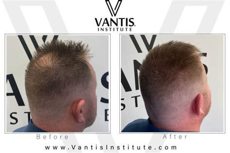 hair restoration follicle replication vantis institute