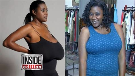 country s largest breast reduction surgery inside edition