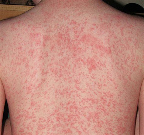 heat rash dermatological diseases epharmapedia