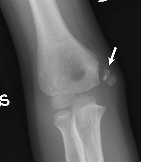 elbow grease lateral  medial condyle fractures   humerus