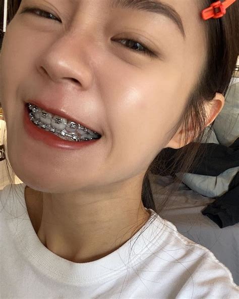 pin by shrood burgos on braces braces girls dental braces colors