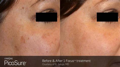 picosure focus before and after photos cosmetic dermatology