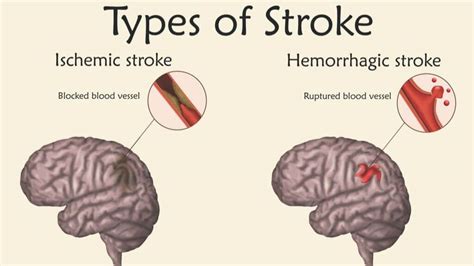 stroke types symptoms  long term outlook md nutrition