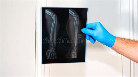 forearm  ray injury doctor examines arm injury medical professional   arm muscle
