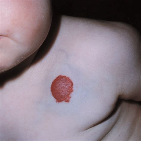 hemangiomas of infancy clinical characteristics morphologic subtypes and their relationship