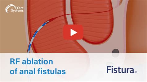 rfa  anal fistulas fistura  care systems  care systems
