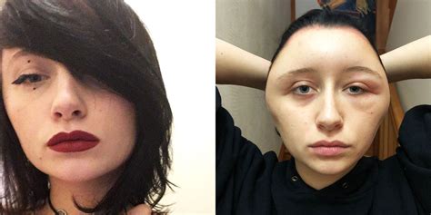woman had severely swollen head after allergic reaction to