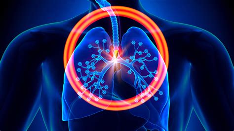 How Lung Cancer Progresses By Stage Eveyday Health