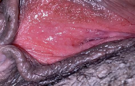 is this herpes or something else very scared sexual